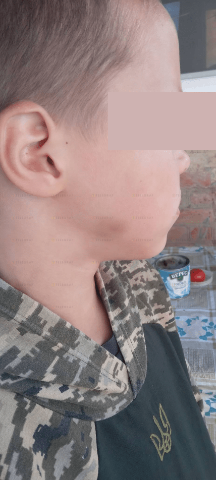 Синці на обличчі хлопчика, Аджамка