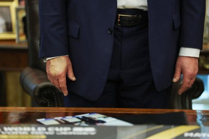 Синці на руці Дональда Трампа