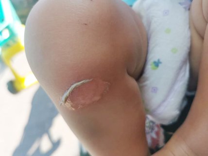 Пострадала тонкая кожа на ножках