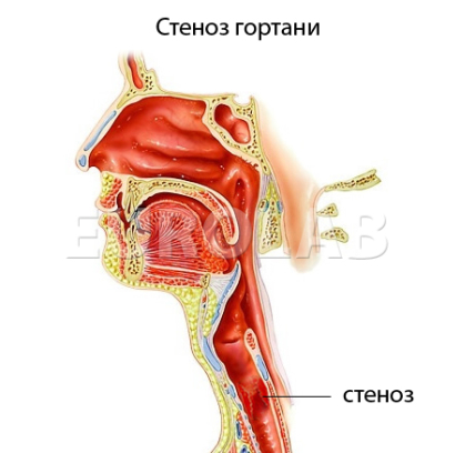Стеноз гортани у детей: симптомы и лечение - изображение №2