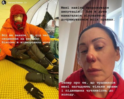 марина філатова ніс відморозила