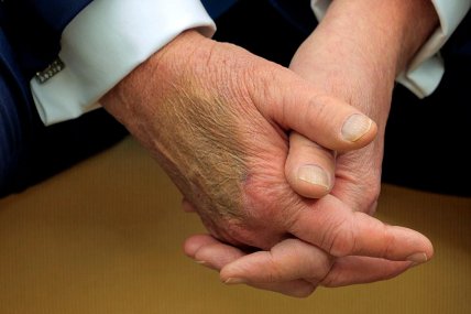 Синяк на руке Трампа, замеченный в феврале 2025 года