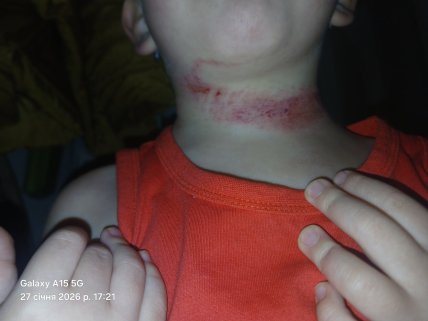Після нападу на шиї хлопця залишились помітні сліди