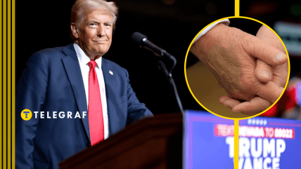 На правой руке Дональда Трампа заметили синяк