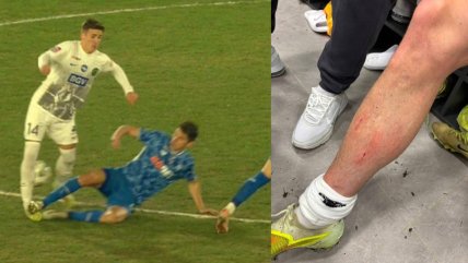 Нога Эмерллаху после стыка с Биловаром