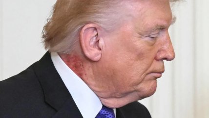 Красное пятно на шее Трампа