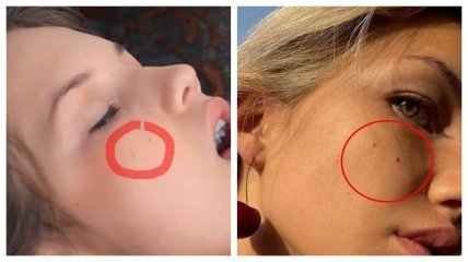 Сравнение родинок