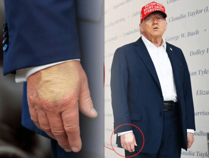 Синяк на руке Трампа