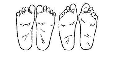 Плоскостопие у ребенка: чем опасен этот диагноз? - изображение №2