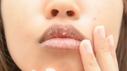 Почему трескаются губы и как с этим быть?