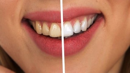 Названы причины желтизны зубов