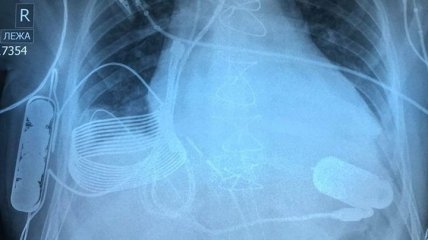 Операция успешная: "бионическое сердце" с возможностью беспроводной зарядки (Видео)
