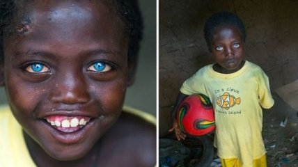 Невероятные глаза африканского мальчика, "подаренные" ему болезнью (Фото)