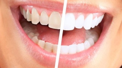 Чем может быть опасно отбеливание зубов дома