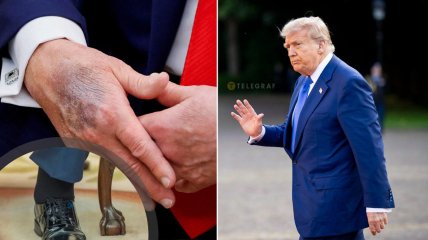 Виразки на руках Трампа