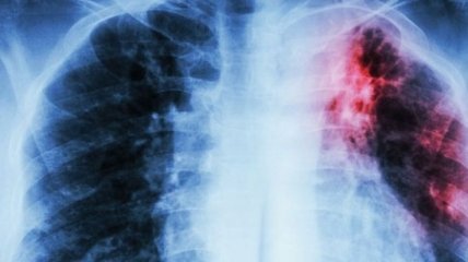 В Украине зарегистрировано инновационное лекарство против туберкулеза