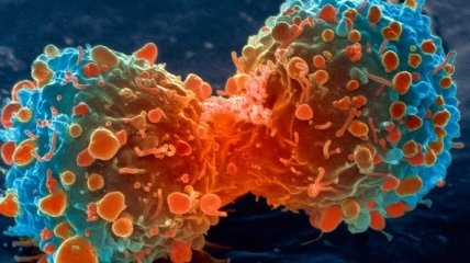 Аномалии в генах, не позволяющие лечить рак молочной железы