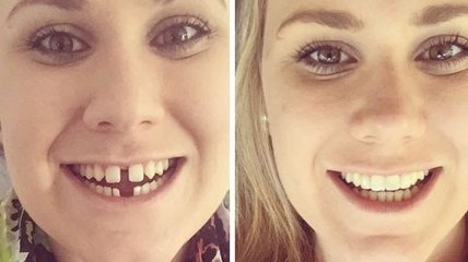 Эти люди исправили свои кривые зубы при помощи брекетов, и теперь их улыбка прекрасна (Фото) 
