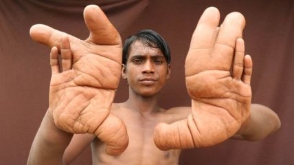 Индийского мальчика прозвали "дьяволом" из-за его огромных рук (Фото)