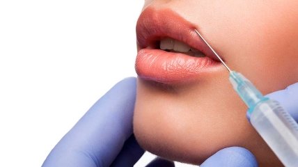Увеличение губ гиалуронкой — стандартная косметическая процедура