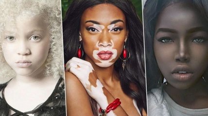 Уникальная красота: люди с самым необычным оттенком кожи (Фото)