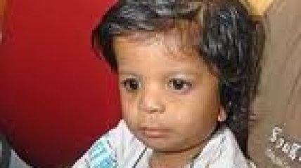 В Индии детей заразили ВИЧ при переливании крови