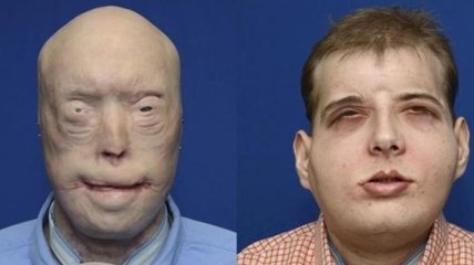 В США провели уникальную операцию полной пересадки лица (Видео)
