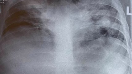 Коронавирус "помолодел": Голубовская показала рентгенограмму 18-летнего пациента