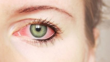 Как справиться с покраснением глаз