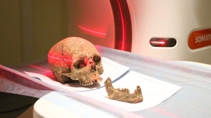 В Тернополе изучают череп с помощью аппарата МРТ