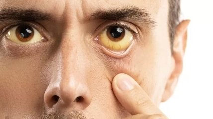 Жовтизна на очах свідчить про захворювання печінки