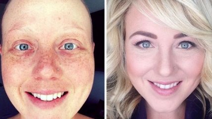 "До и после": люди, которые победили рак (Фото)