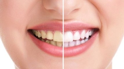 Самый простой способ отбеливания зубов