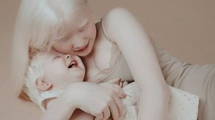 Теплые фотоснимки сестренок-альбиносок из Казахстана растопят ваше сердце (Фото)