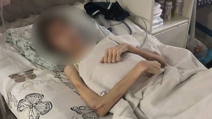 Одессит постом "лечил" сына от бесов: подросток весил 30 килограммов при росте в 180 см