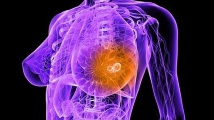 Ученые выяснили, что провоцирует рак груди