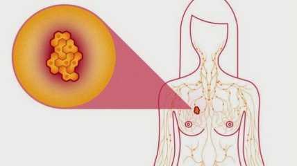 Ранняя диагностика рака груди: что нужно знать каждой женщине