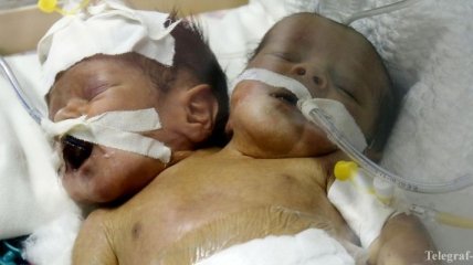 Одно тело на двоих: в Йемене родились необычные сиамские близнецы