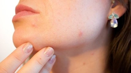 Рацион для кожи: 5 продуктов которые избавят от прыщей на лице