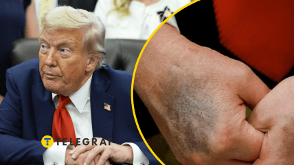 Дональд Трамп прикрывает синяк