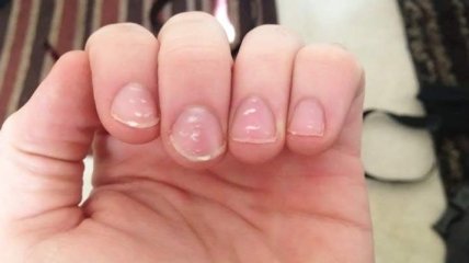 Почему появляются "белые пятна" на ногтях у ребенка