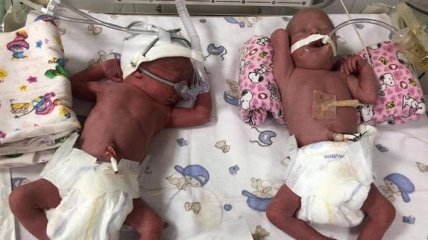 В Ужгороде женщина родила четверняшек: ей сделали уникальную операцию (видео)
