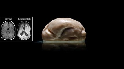 Самый необычный человеческий мозг из известных науке