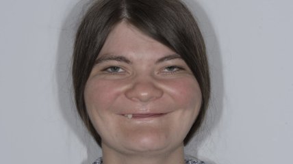 Ольга Мацик у 32 роки мала всього 3 зуби