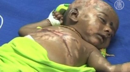 Индийский младенец страдает от самовоспламенения