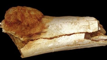 Найден старейший образец рака в кости раннего человека 