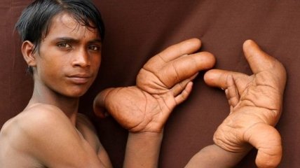 12-летний мальчик с гигантскими руками, который не сможет учиться в школе (Фото) 