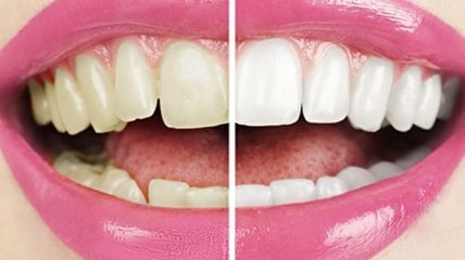 Врачи назвали простой, но эффективный способ отбеливания зубов дома