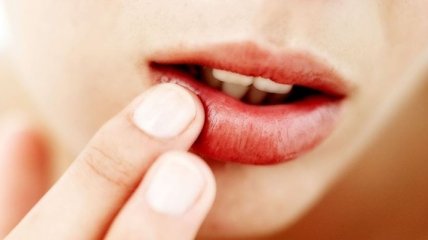 Как предотвратить появление герпеса на губах?