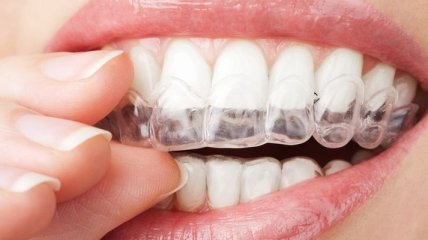Зубы можно отбелить дома